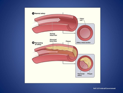 Atherosclerosis is a disease of your cardiovascular system