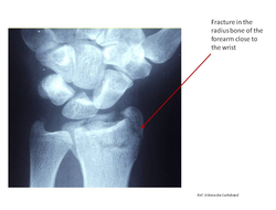 Osteoporosis can result in wrist fractures